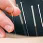 Acupuncture